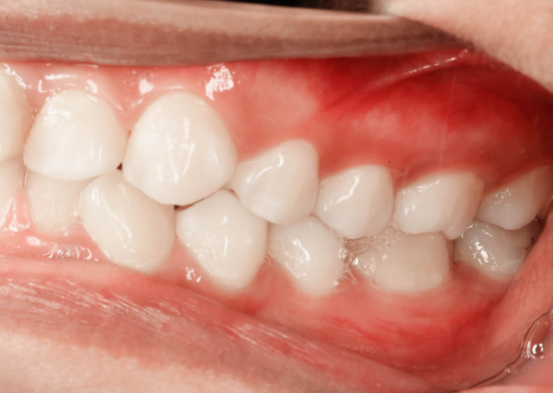 Protecting you against Gum Disease at Eledent Smiles