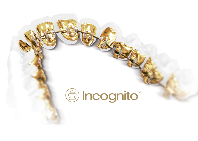 What are the advantages of Incognito Braces