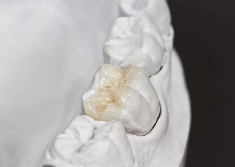 Why come to us for Inlays & Onlays