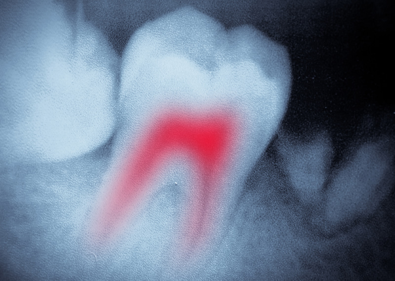 Why come to us for Root Canal Treatment