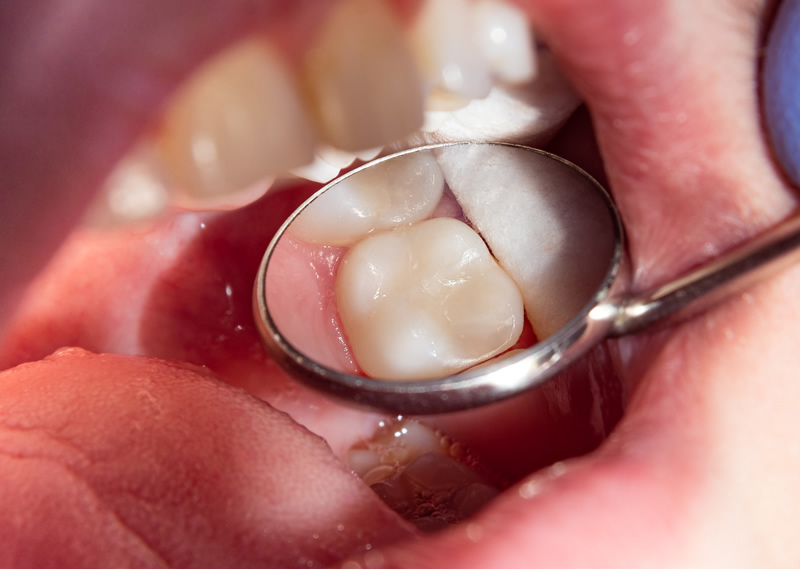 Why come to us for White Fillings